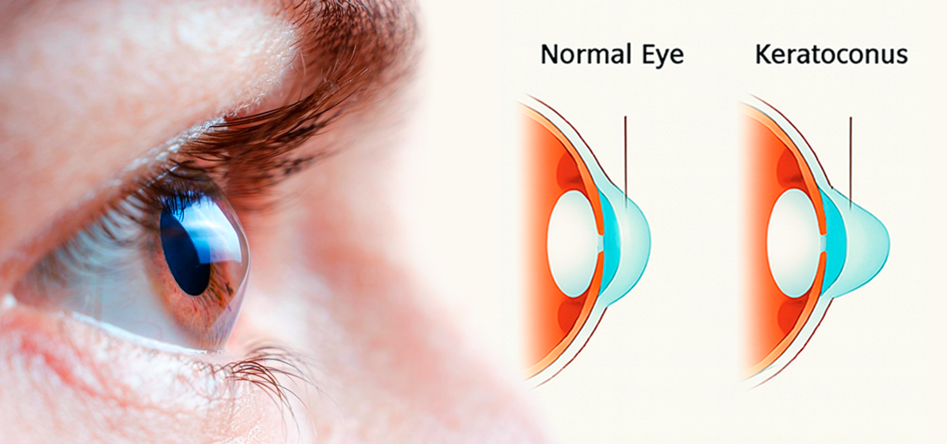 Keratoconus