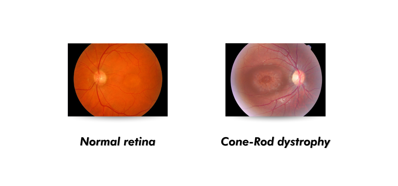 Cone Dystrophy Causes