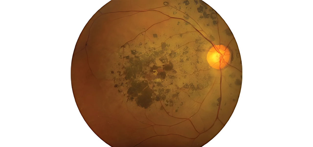 What is Cone-Rod Dystrophy