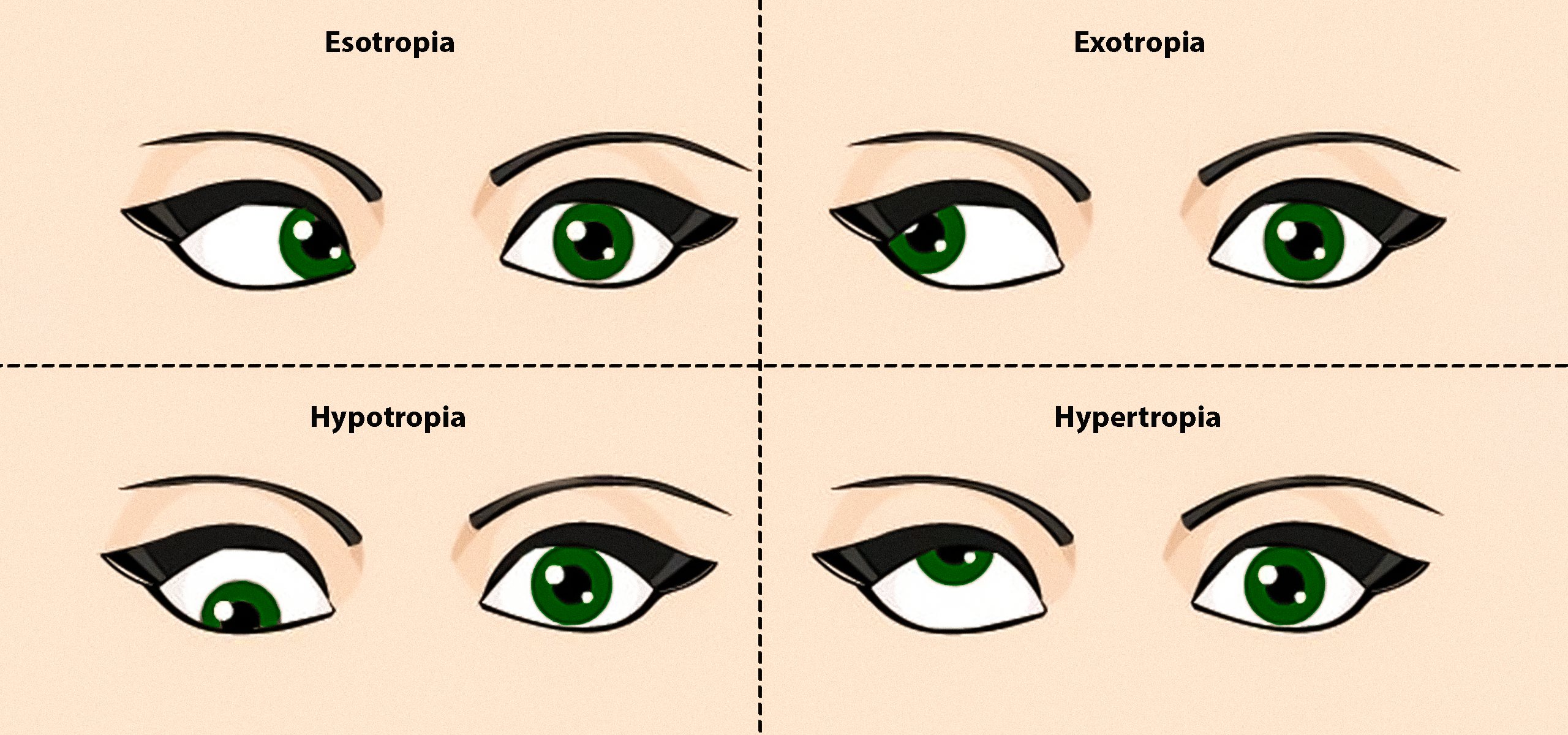 Causes, Types, and Treatment